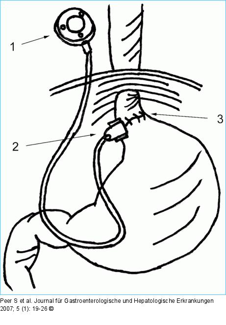 Magenbandimplantation