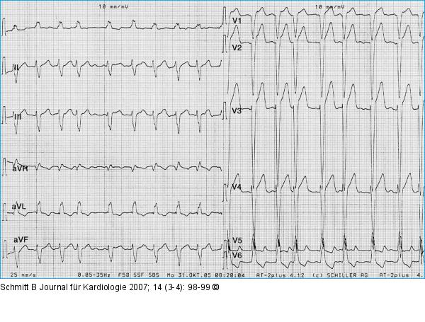 Tachykardes Vorhofflimmern