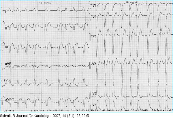 ST-Hebung - Posterolateralbereich