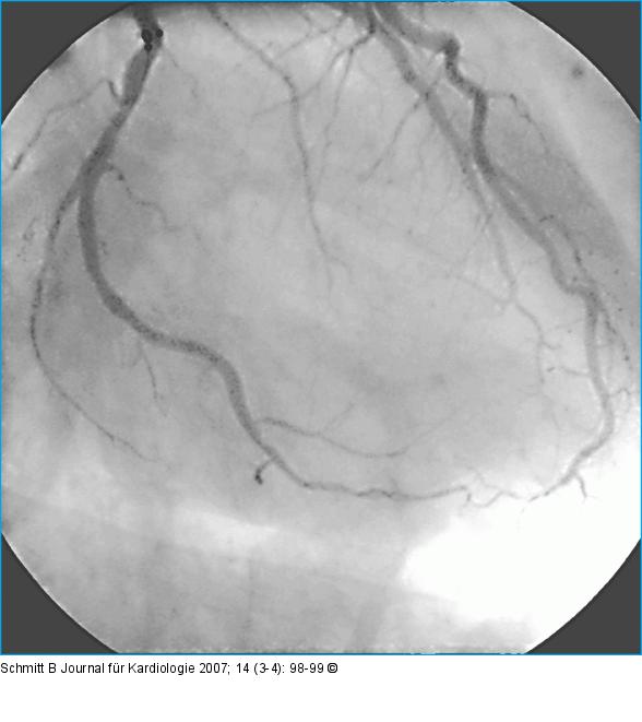 Rekanalisation - Ballondilatation
