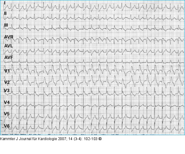 Breitkomplextachykardie