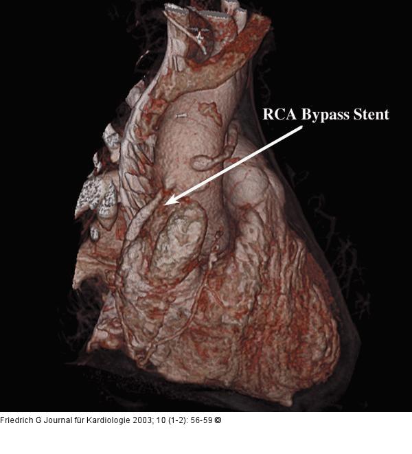 RCA-Bypass-Stent