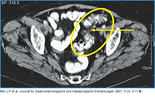 Chronische Sigmadivertikulitis mit Wandverdickung