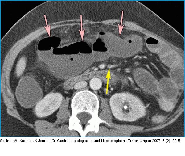 CT-Bild in axialer Schichtführung