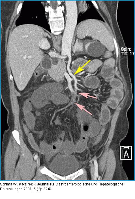 3D-Rekonstruktion der CT