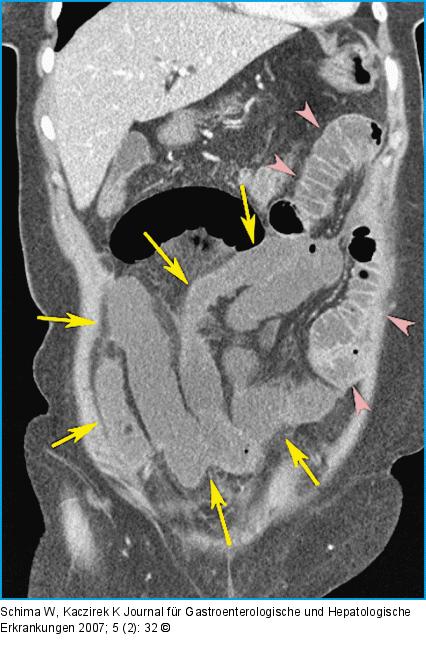 CT-Rekonstruktion in koronaler Ebene