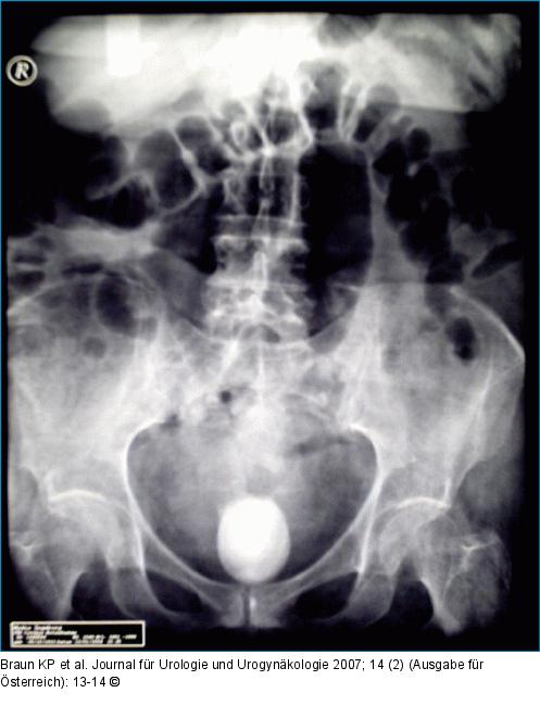 Abdomenübersichtsaufnahme