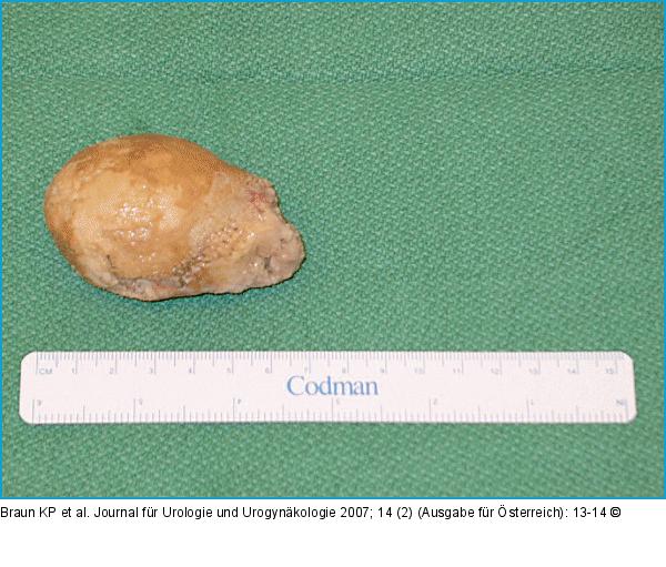 Harnblasenkonkrement