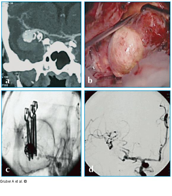 Mikrochirurgische Klippung