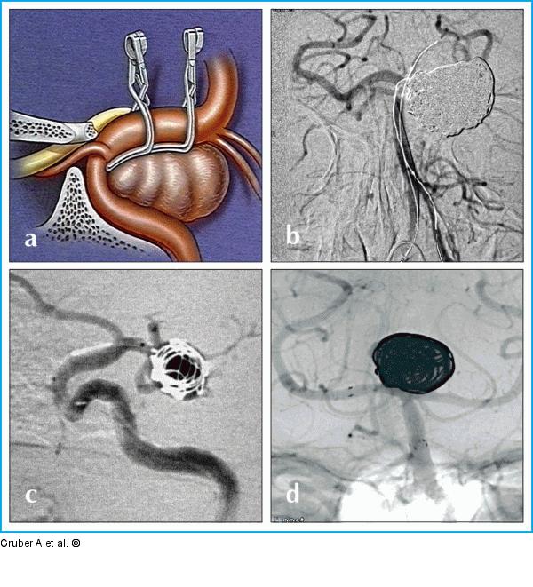 Chirurgie - Endovaskuläres Verfahren
