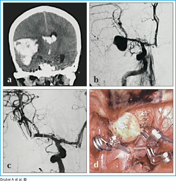 Mikrochirurgische Klippung