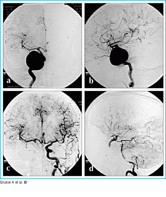 Therapeutischer endovaskulärer Gefäßverschluß