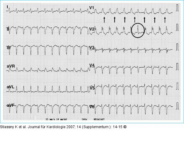 Abbildung 2 12 Kanal EKG Abbildung 2 12 Kanal EKG