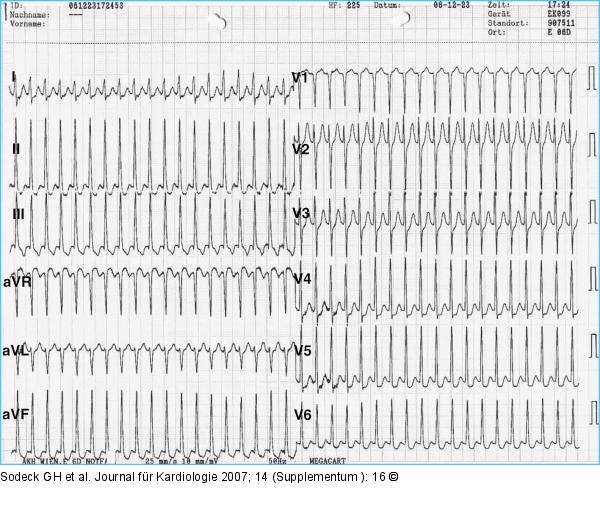 Abbildung 1 12 Kanal EKG Abbildung 1 12 Kanal EKG