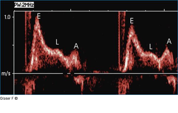 Gepulster Doppler - Mitraldoppler