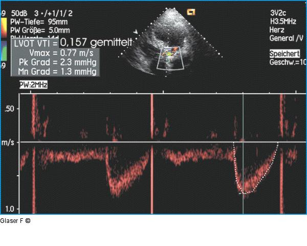 Gepulster Doppler - LVOT