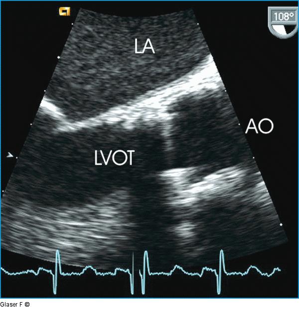 Transösophageales Echo - Aortenklappe