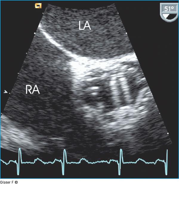 Transösophageales Echo - Aortenklappe