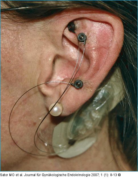 P-StimTM, Ohrakupunkturpunkte Uterus (57), Shen Men (55) und Polster (29)