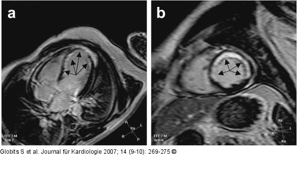 Gradientenechosequenz