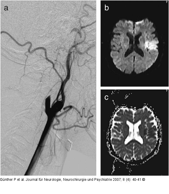 Arteria carotis - Dissektion