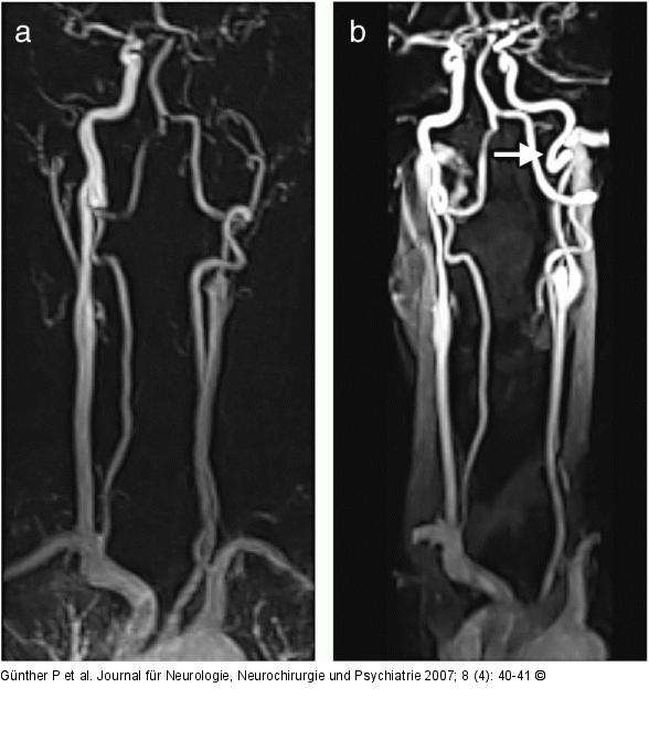Arteria carotis - Dissektion