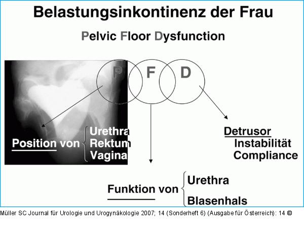 Belastungsinkontinenz - Frau