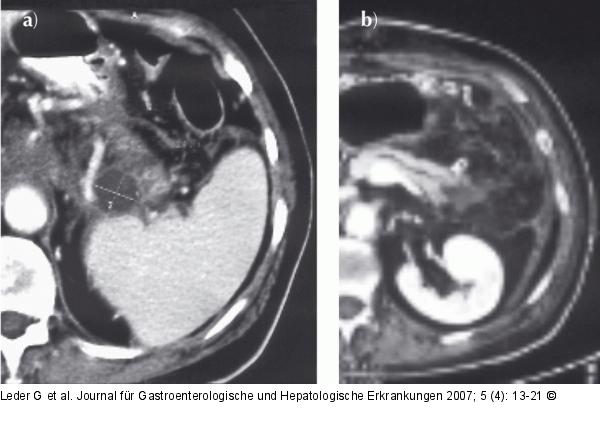 Chronische Pankreatitis