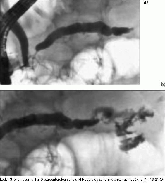 Chronische Pankreatitis