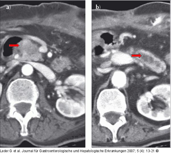 Chronische Pankreatitis