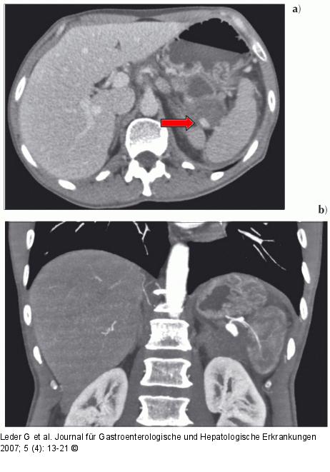 Chronische Pankreatitis