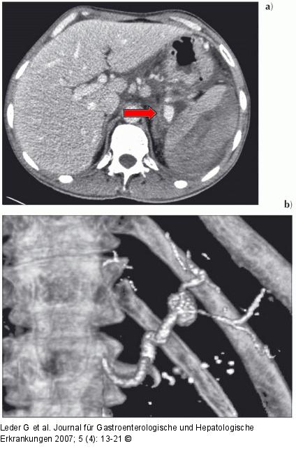 Chronische Pankreatitis