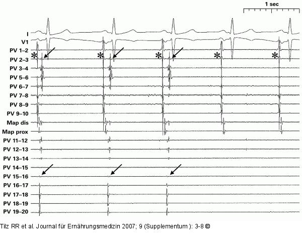 EKG-Ableitung