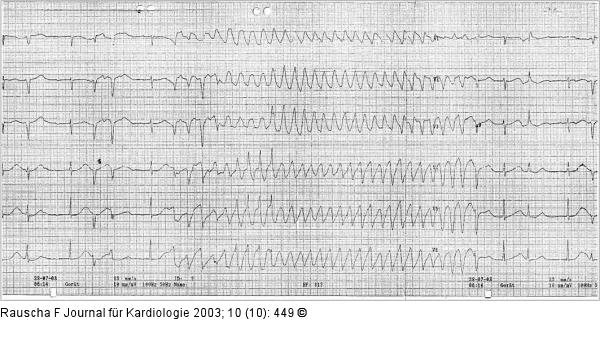 Torsade de pointes-Tachykardie