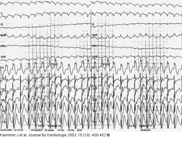Ventrikuläre Tachykardie