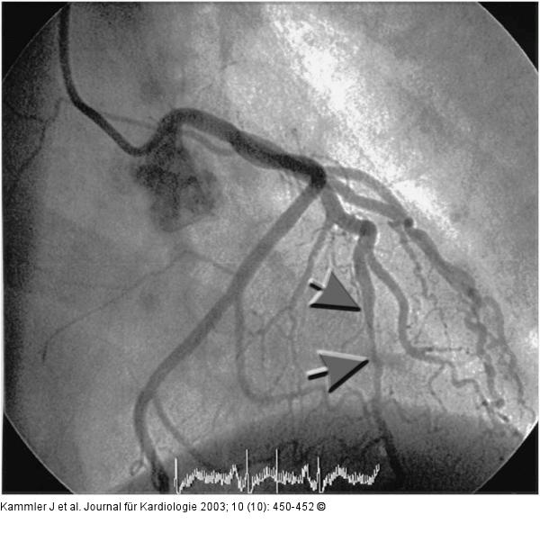 Systolische Komprimierung - Arteria coronaria sinistra