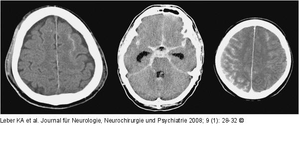 Traumatische Subarachnoidalblutung