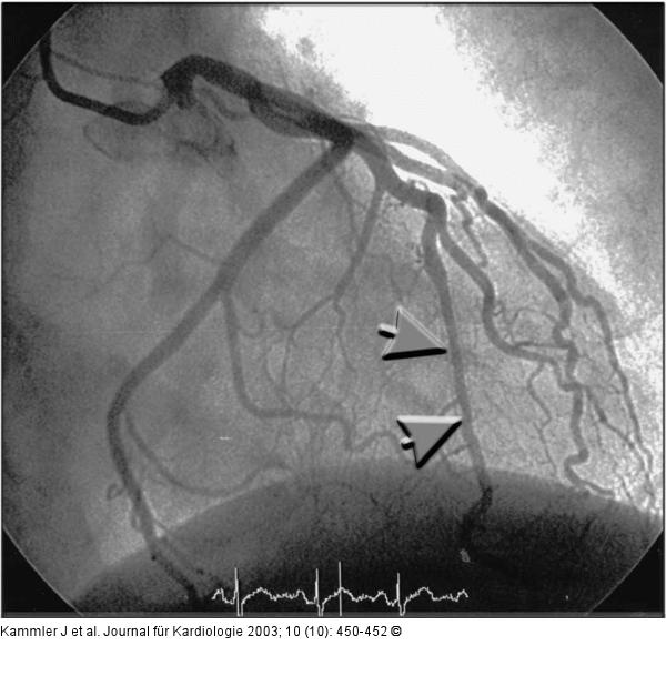Arteria coronaria sinistra - Stent