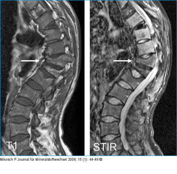Wirbelkörperfraktur