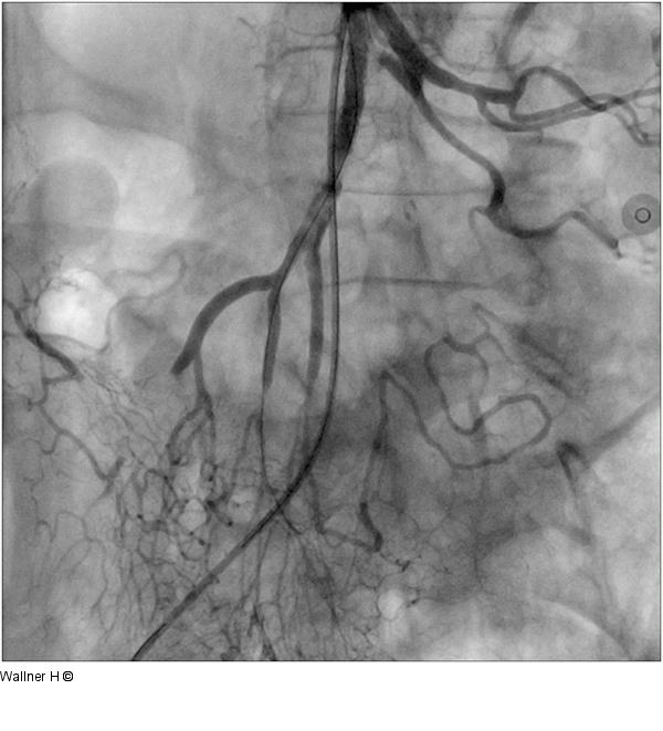 Zweifachstentimplantation