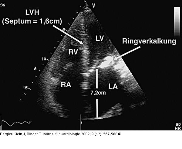 Mitralklappen - Ringverkalkung