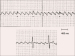 Abb. 1: EKG