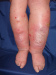 Abb. 1: Stauungsdermatitis