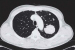 Fig. 3: Thoracic CT