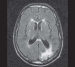 This Image - Fig. 4: FLAIR-MRI