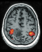 Fig. 1: Brain tumour 