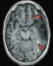 Fig. 2: Brain tumour