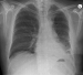 Abb. 2: Thoraxr�ntgen