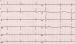 Aktuelles Bild - Abb. 1: Bradyarrhythmia absoluta