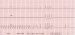 Abb. 2: EKG - Monitoring